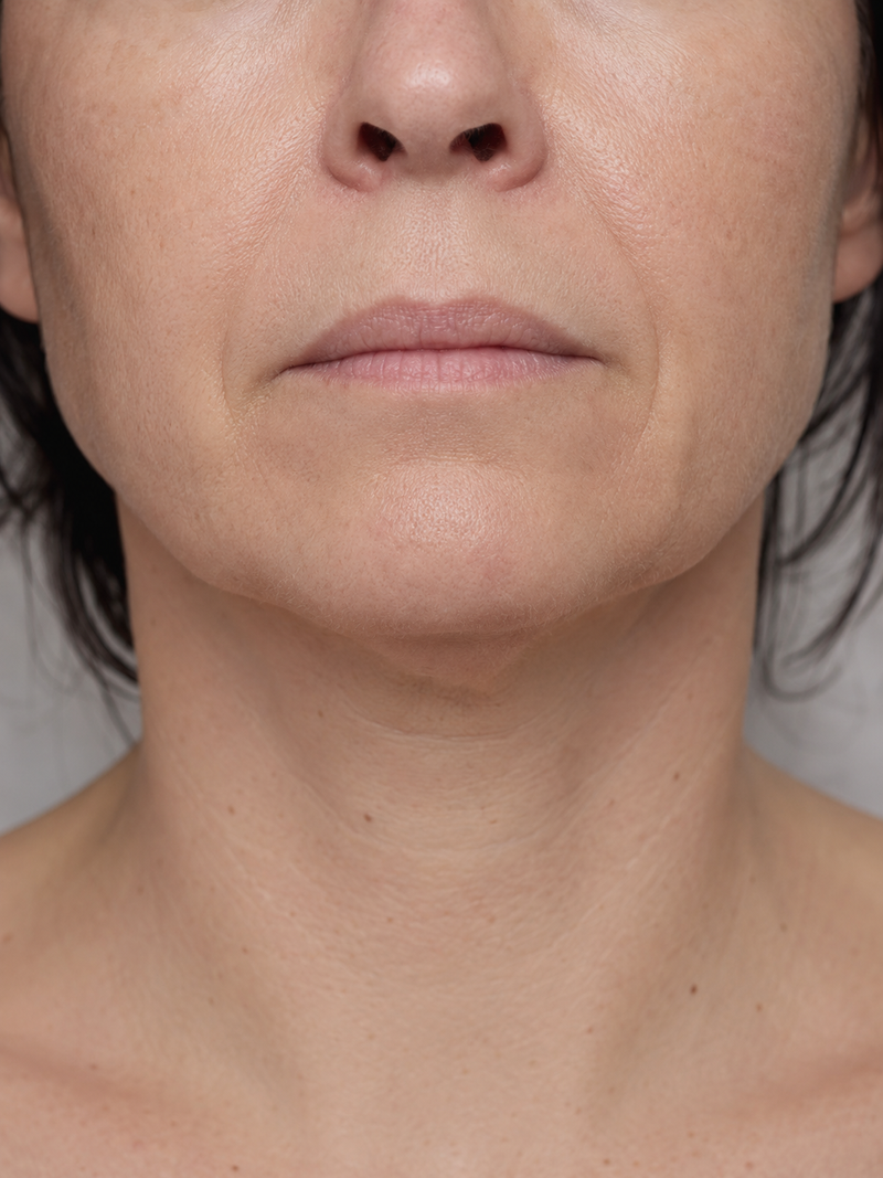 Sarah M., 48 — 6 weeks · Firmness & fine lines