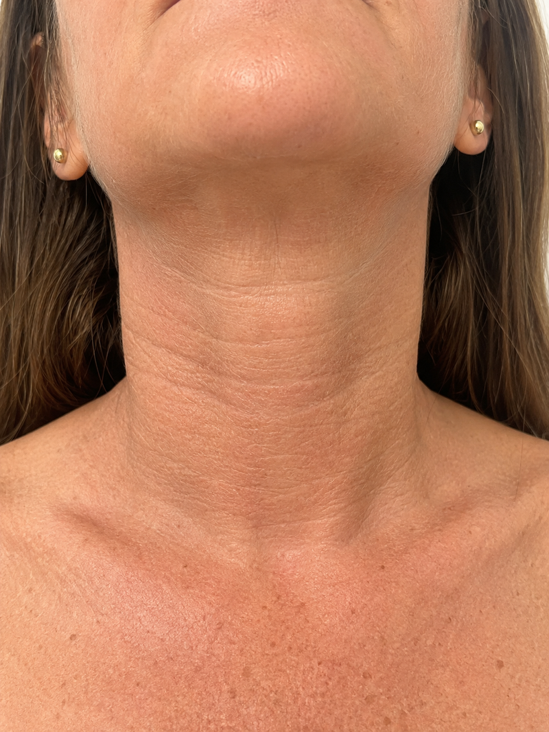 Patricia L., 51 — 6 weeks · Neck lines