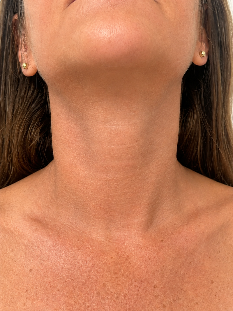 Patricia L., 51 — 6 weeks · Neck lines